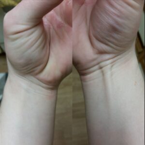 Palmaris Longus Muscle